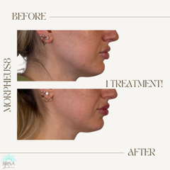 m8 after 1 treatment submental fat