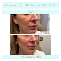 midfacePDOthreadLift2