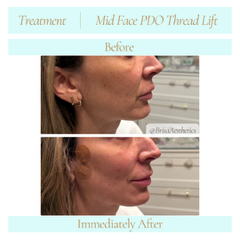 midfacePDOthreadLift3