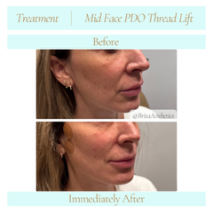 midfacePDOthreadLift4