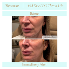 midfacePDOthreadLift6