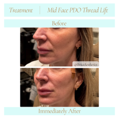 midfacePDOthreadLift7