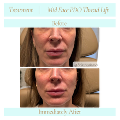 midfacePDOthreadLift8