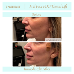 midfacePDOthreadLift9