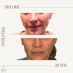 sculptra 6 months post tx