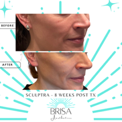 sculptra-8 weeks post tx 1