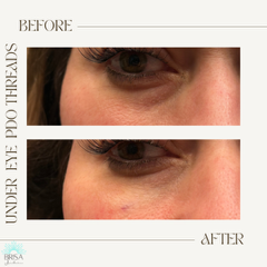 undereyepdothreads1 copy